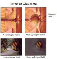 Glaucoma Effects